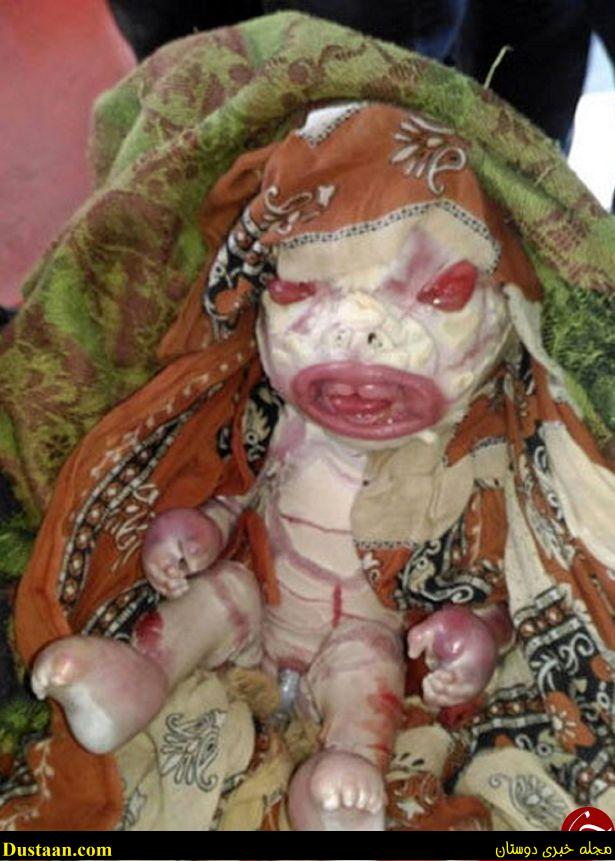 www.dustaan.com-تولد نوزاد نفرین‌ شده با قیافه ای ترسناک در هندوستان + تصاویر