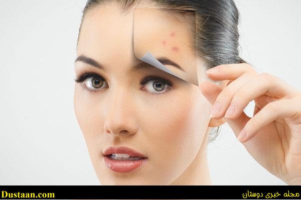 www.dustaan.com-dustaan.com-treatment acne naturally درمان جوش صورت فوری و طبیعی