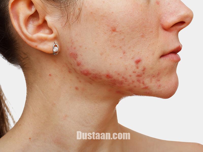 http://img.medscape.com/thumbnail_library/shs_160415_acne_face_cheek_800x600.jpg