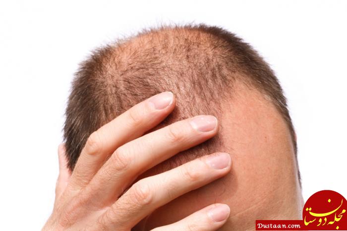 https://cdn1.medicalnewstoday.com/content/images/articles/315/315859/man-balding.jpg