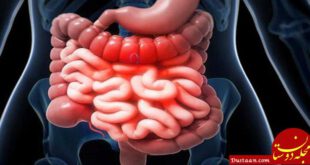 https://salamati.ir/wp-content/uploads/2017/05/Crohn-disease-760x400.jpg