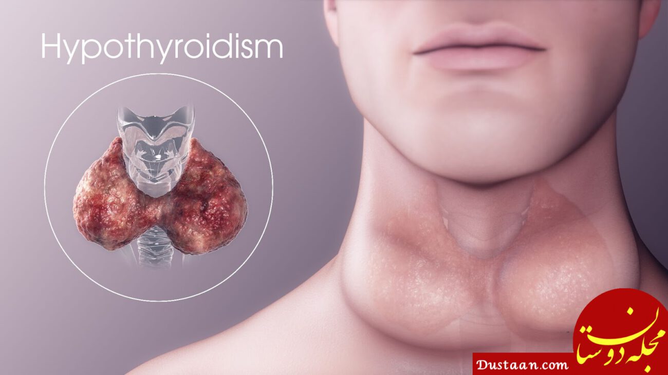 http://www.blog.drvikram.com/wp-content/uploads/2019/01/What-is-Hypothyroidism.jpeg