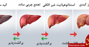 https://aristeh.com/wp-content/uploads/2018/05/Fatty-Liver.jpg