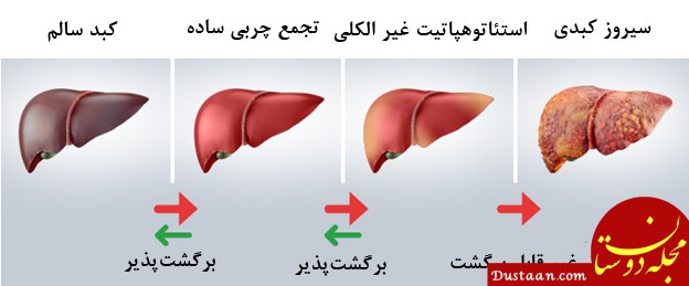 https://aristeh.com/wp-content/uploads/2018/05/Fatty-Liver.jpg