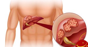 سرطان کبد چیست؟ + نشانه ها و راههای پیشگیری